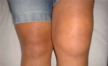 The causes of knee arthrosis joint