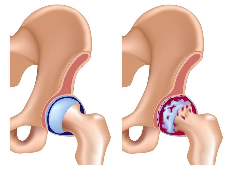 Straight and hip arthrosis